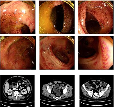 Fecal Microbiota Transplantation Effectively Cures a Patient With Severe Bleeding Immune Checkpoint Inhibitor-Associated Colitis and a Short Review